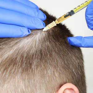 Плазмотерапия для волос — Cortexil PrP